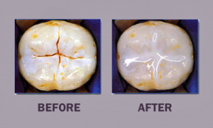dr mancuso sealants