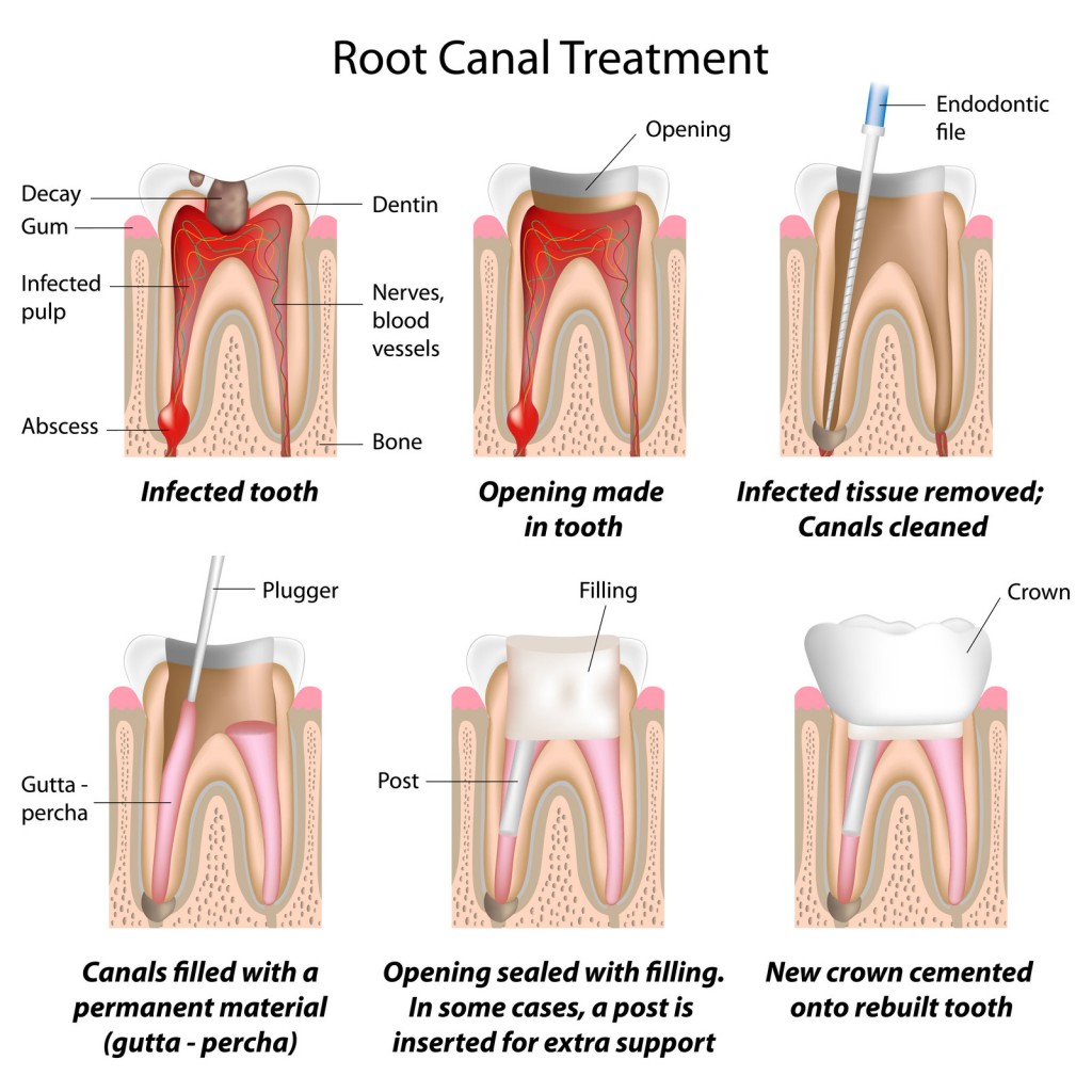 root canal dr. mancuso fair lawn, nj