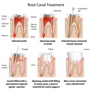 dr mancauso root canal