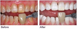 Before & After Teeth Whitening