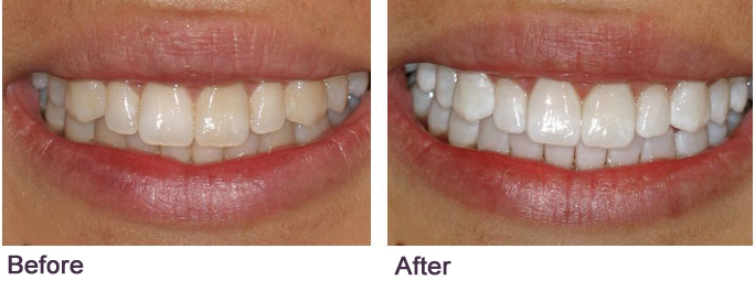 teeth whitening Dr. Mancuso fair lawn nj