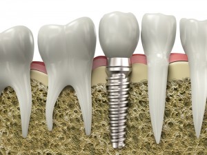 dental implants dr mancuso fair lawn nj