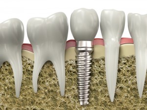 DR. Mancuso implants